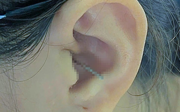 Chồng bất ngờ ôm vợ trong lúc vợ đang ngoáy tai làm dị vật đâm sâu vào tai trái - Ảnh 1. Chồng bất ngờ ôm vợ trong lúc vợ đang ngoáy tai làm dị vật đâm sâu vào tai trái - Ảnh 2.